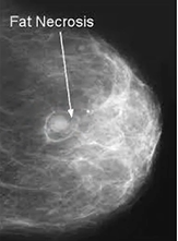 <p>i. Enzymatic type </p><ul><li><p>only occurs around pancreas</p></li><li><p>associated with adipose tissue injury and release of pancreatic lipases (ie. in alcoholics)</p></li></ul><p> ii. Traumatic type </p><ul><li><p>occurs when adipose tissue in any site is injured by trauma</p></li><li><p>ie. injury to breast tissue following surgery</p></li></ul><p></p>