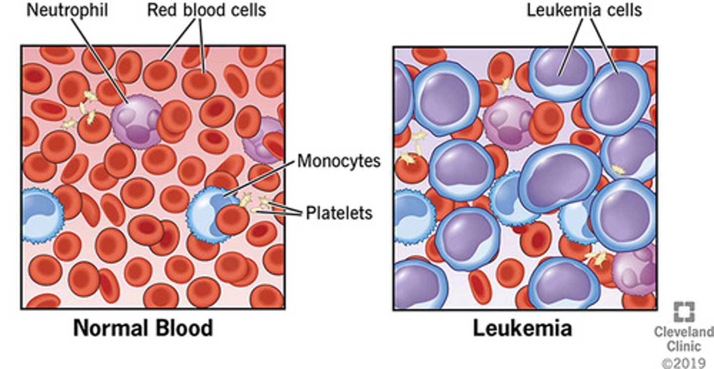 <p>Cancers of the blood, caused by the overproduction of abnormal WBCs</p>