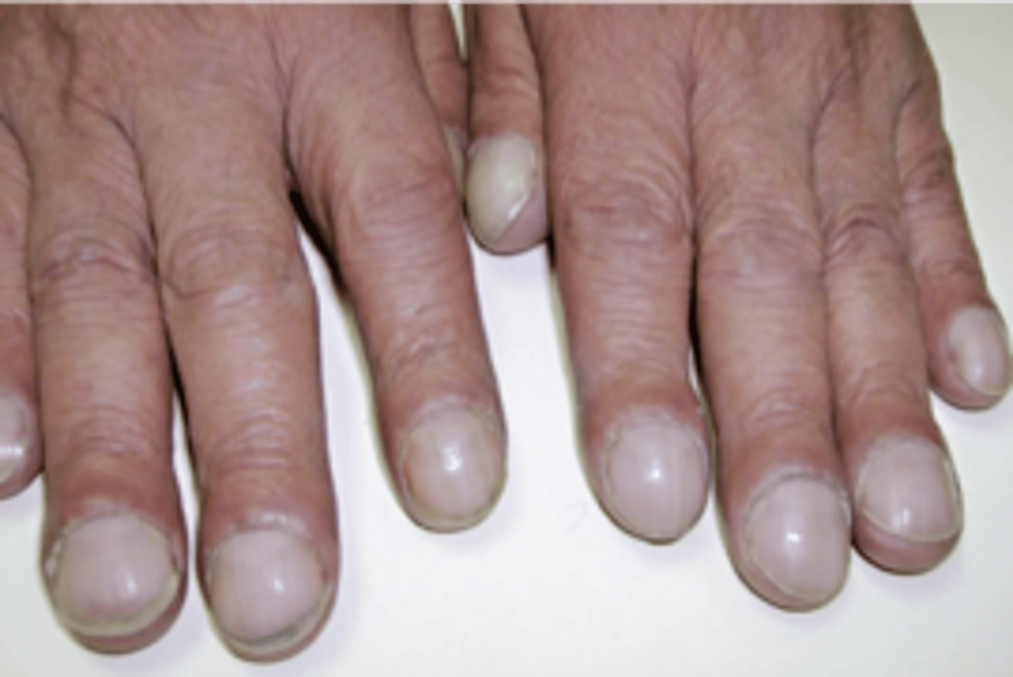 <p>what is this nail abnormality?</p>