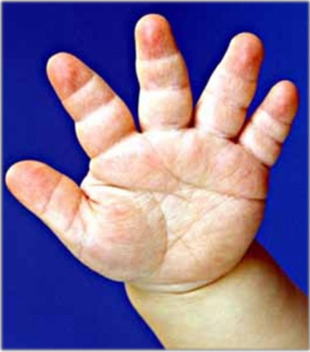 <p>Achondroplasia</p>