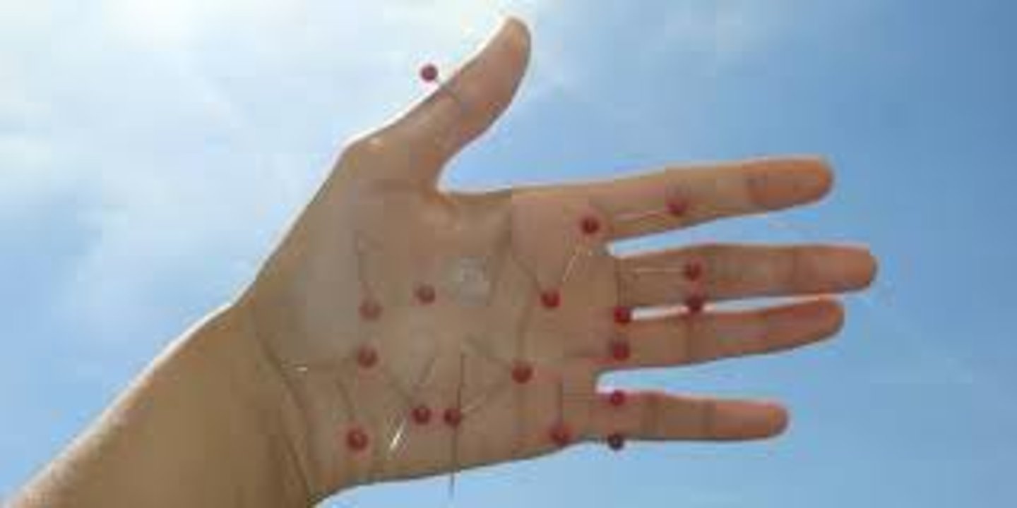 <p>neuropathy that manifests as persistent anesthesia or an altered sensation ranging from complete numbness to burning, tingling, or continual pain</p>