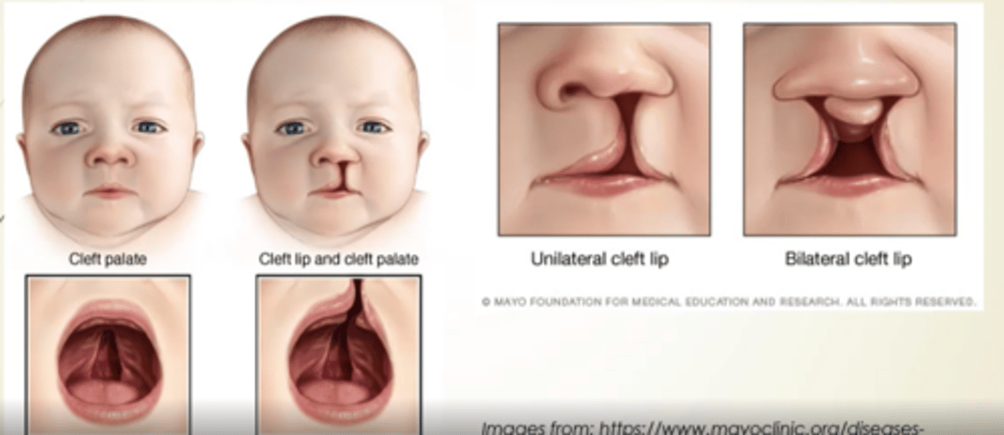<p>What is one of the most common major congenital defects? </p>