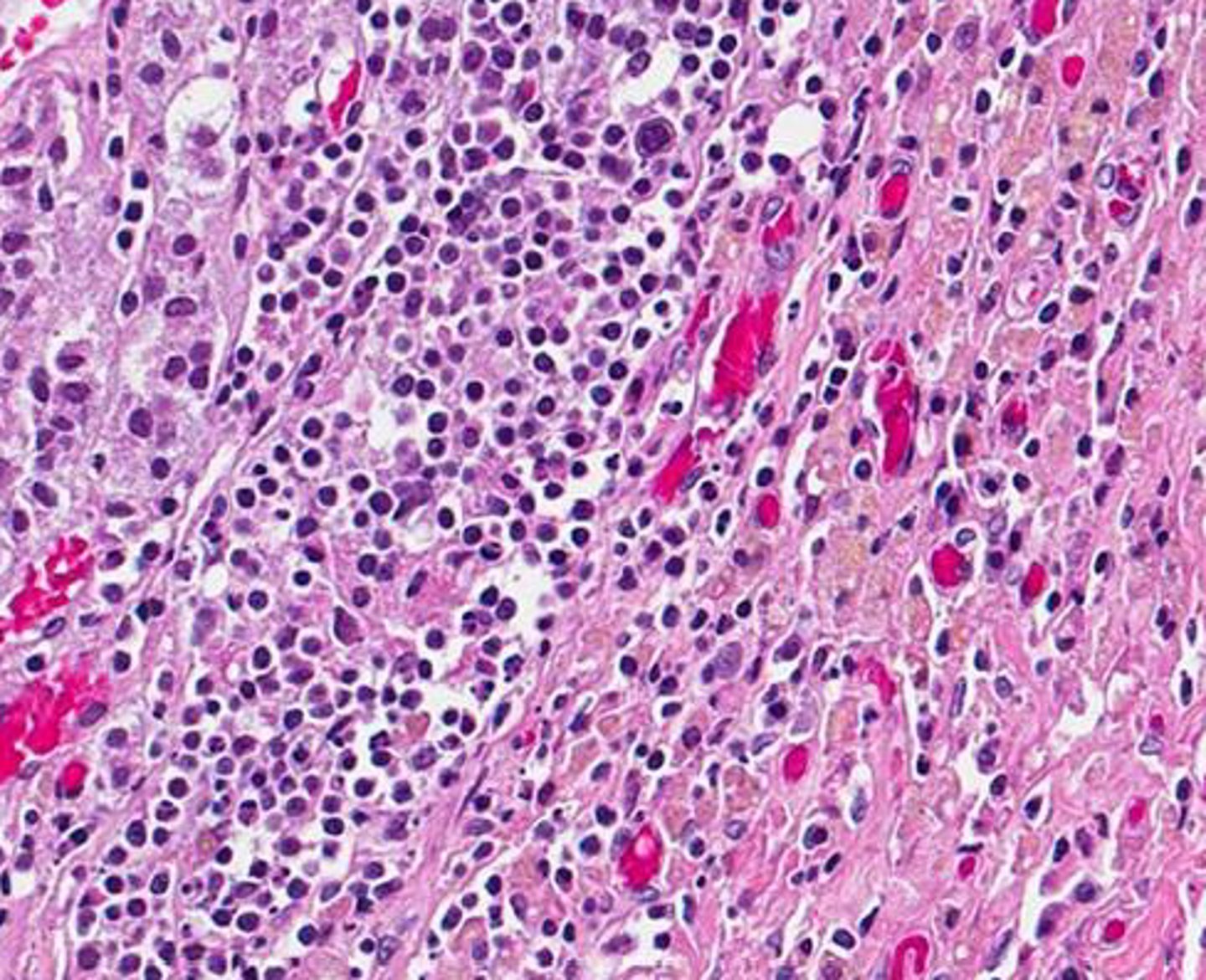 <p>Define Cause of Primary Adrenocortical Insufficiency:</p><p>-Hx:</p><p>&gt; MCC of Primary Adrenocortical Insufficiency in HIGH INCOME COUNTRIES</p><p>-Path/Sx/PE: May be a/w Autoimmune Polyglandular Syndrome (APS) 1</p><p>&gt; Adrenocortical Insufficiency</p><p>&gt; Muco-cutaneous Candidiasis</p><p>&gt; Hypoparathyroidism</p><p>-Dx:</p><p>&gt; Gross: Adrenal glands are irregularly shrunken due to autoimmune destruction</p><p>&gt; Micro: Lymphocytic infiltrate in cortex</p>