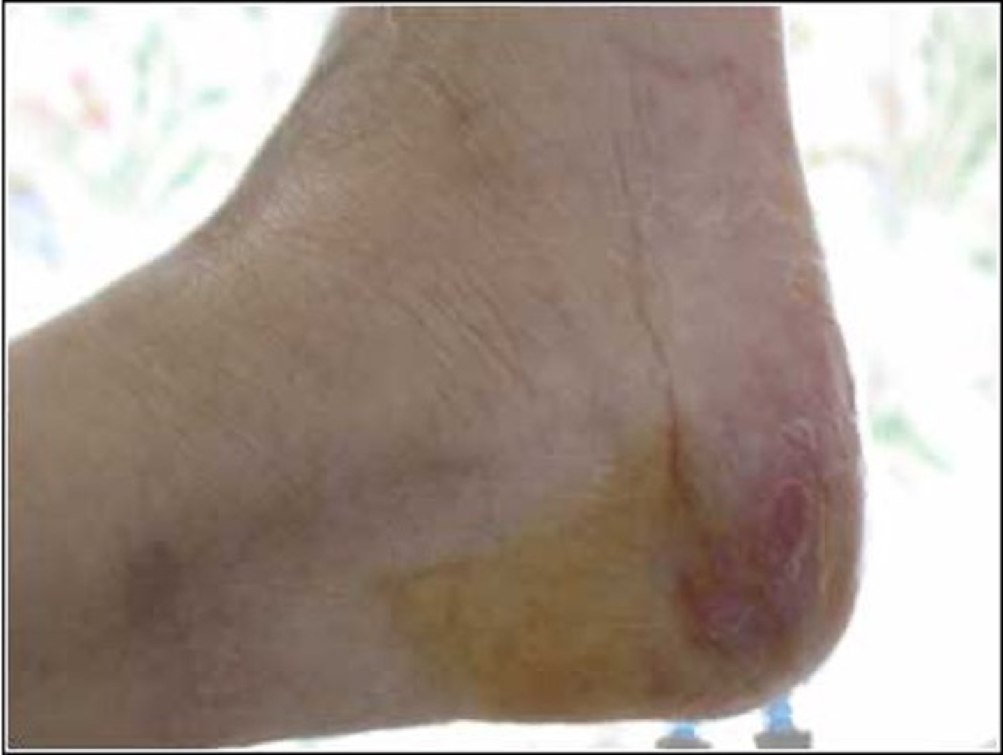 <p>Partial thickness with damage to dermis/epidermis</p><p>Cracked skin (blistered/broken)</p><p>Can often re-epitheialize if pressure removed</p>