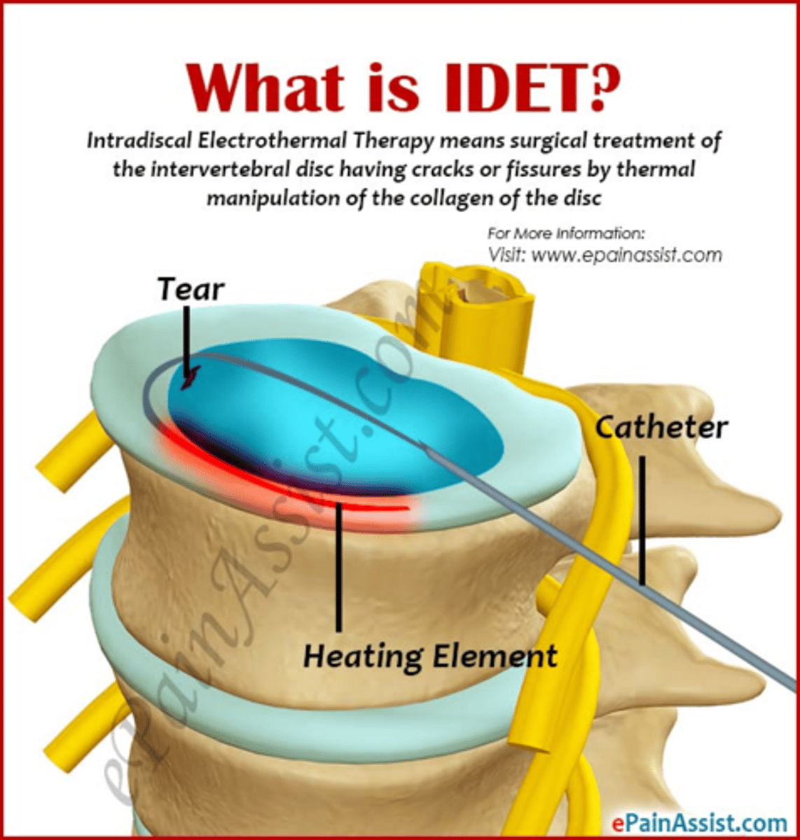 <p>intradiscal electro-thermoplasty (IDET)</p>