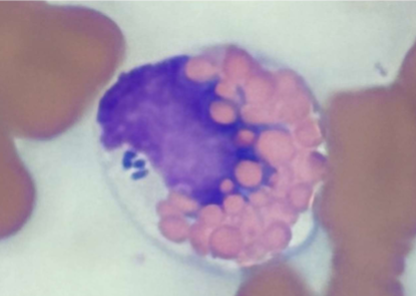 <p>what does&nbsp;<span style="color: rgb(254, 254, 254);"><span>A. phagocytophilum cause</span></span></p>