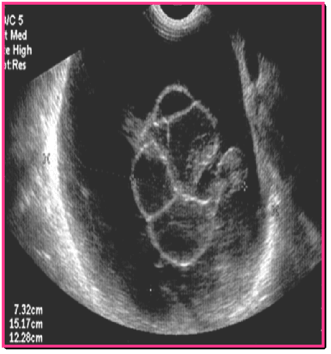 <p>mucinous cystadenocarcinoma</p>