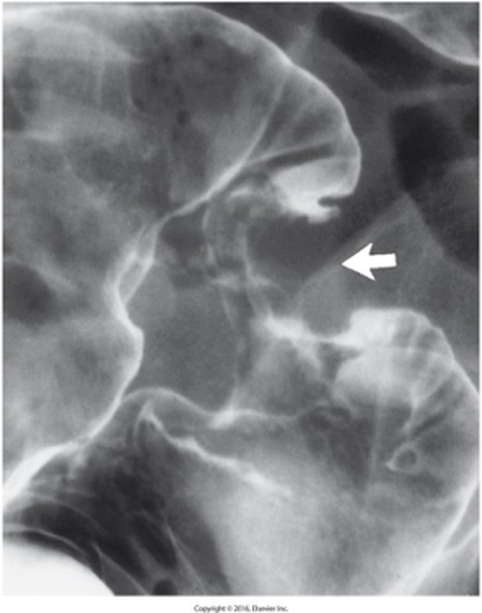 <p>What is the imaging appearance of colon cancer</p>