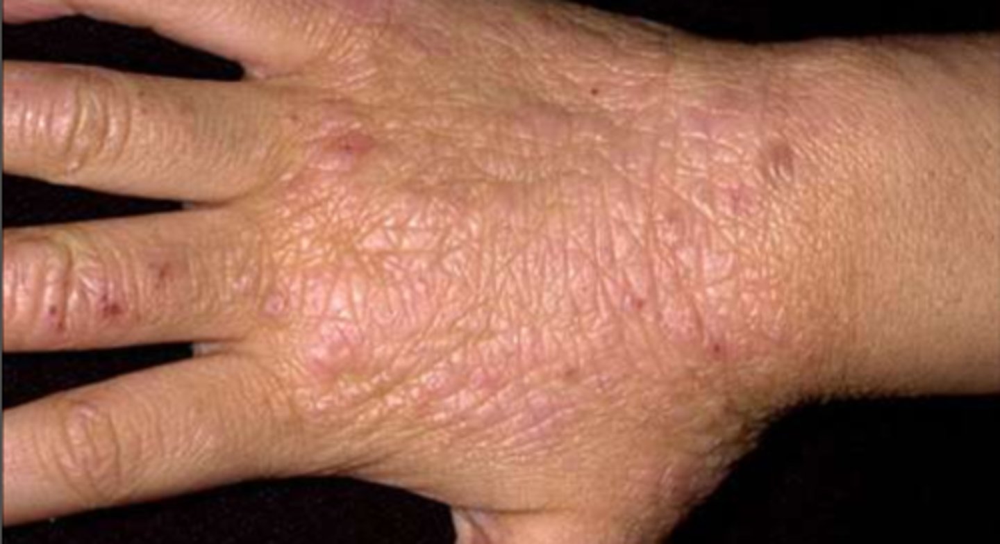 <p>¿lesión?</p><p>¿primaria o secundaria?</p>