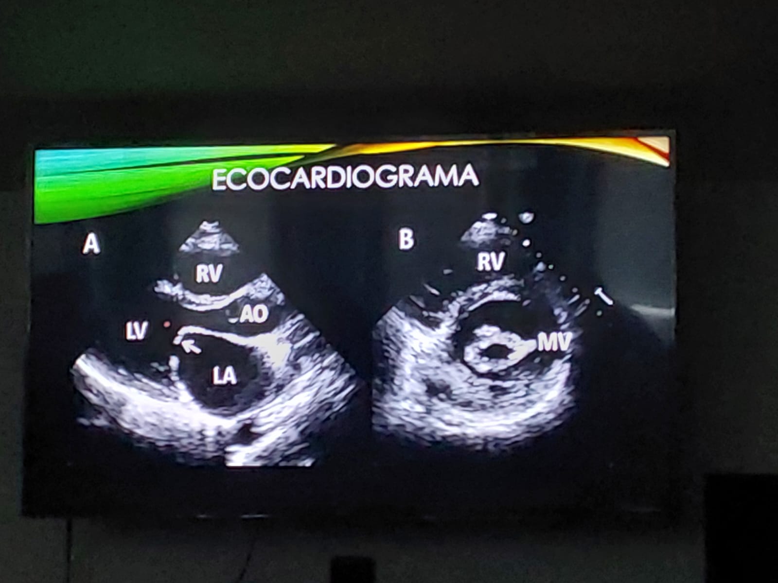 <p>En la siguiente imagen de ecocardiograma, ¿A qué corresponde la imagen señalada con la flecha?</p>