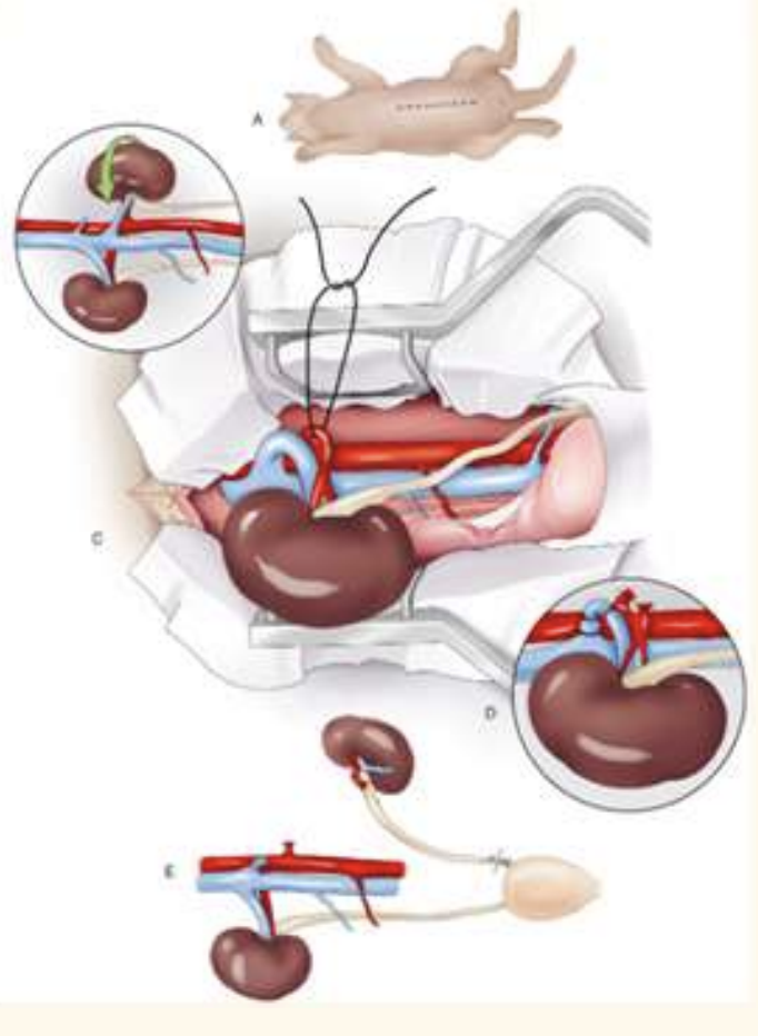 <p>ventrla midline approach</p><ol><li><p>identify kidney with duodenal/ colonic nerves</p></li><li><p>kidney sit in fatty pounch (retoperitoneal flat)—> blunt dissect kidney w digit</p></li><li><p>identify arterys and veins. —> thicker is artery, ;</p></li><li><p>circumfrential/ transfixing suture to ligate ligate a first (prevent engorgement)</p><ul><li><p>remember to place ligature on each side and resect in between </p></li></ul></li><li><p>elevate kidney, dry swap all the way down ureter down bladder</p></li><li><p>suture x2, resection as close to bladder as possible</p></li></ol><p></p><p></p>