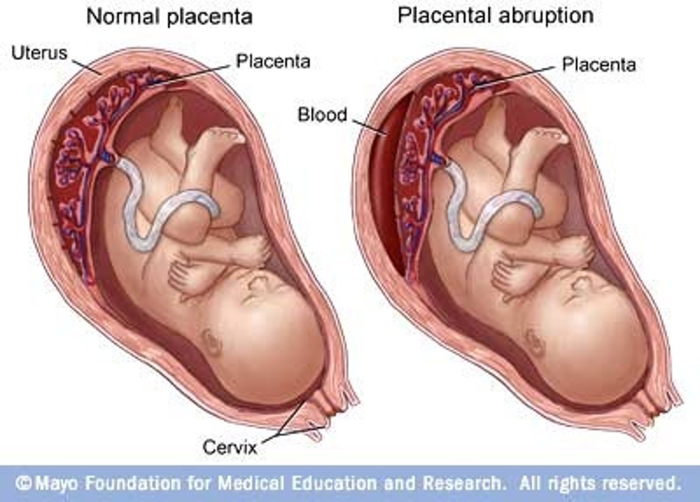 <p>Serious and urgent condition due to bleeding/damageto placenta. May necessitate immediate delivery</p>