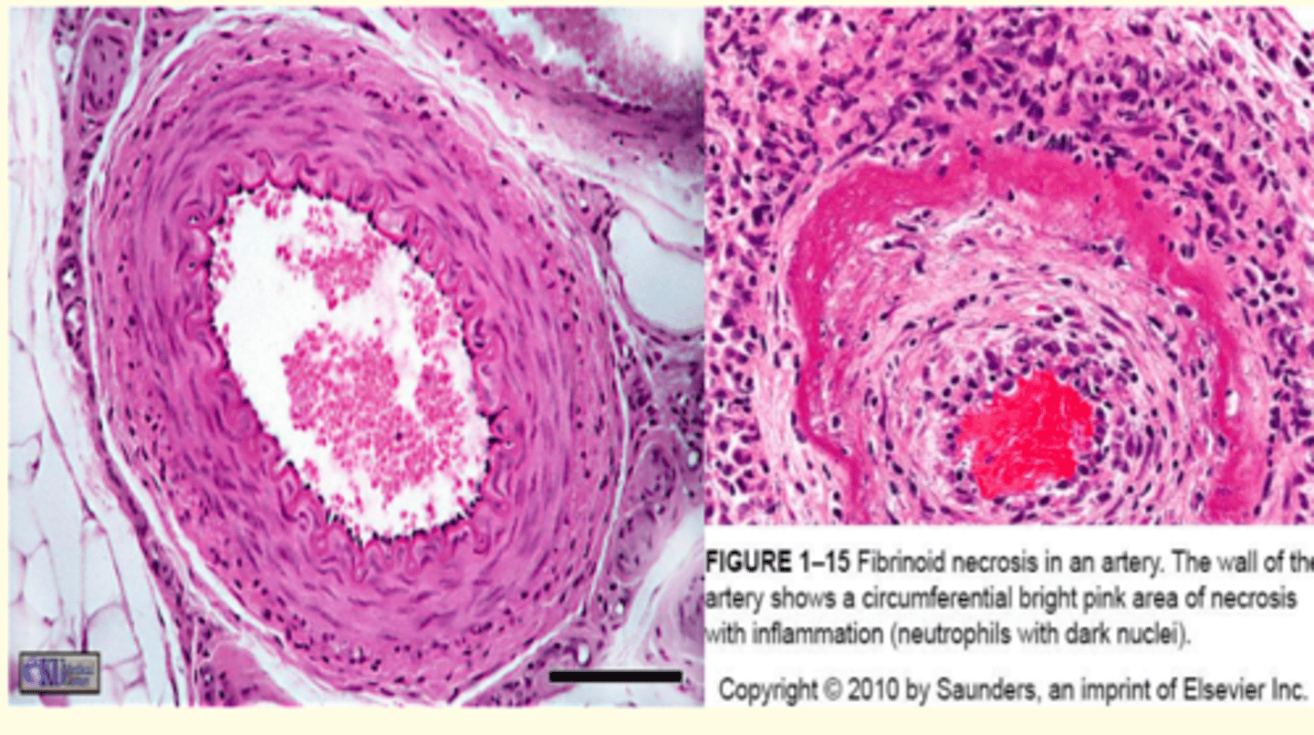 <p>Fibrinoid necrosis of a blood vessel</p>