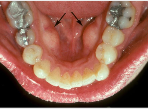 <p>outgrowths of normal dense bone on lingual of mandibular premolar area</p>