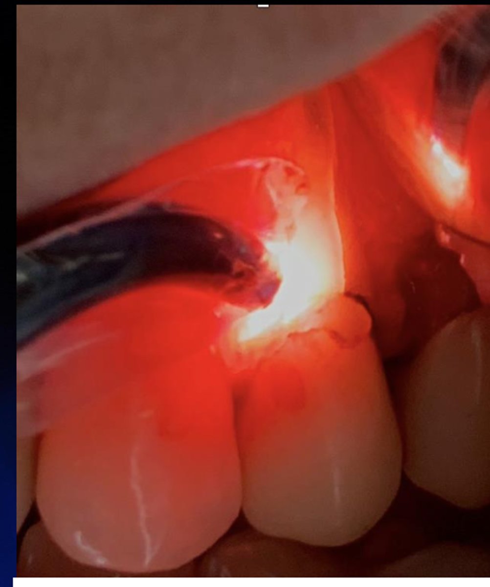<p>Which test can reveal hidden decay or a fractured tooth, used for suspicion of cracks/fracture?</p>