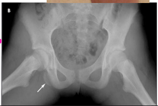 <p><strong>Hamstring Strain: S/S, Diagnosis, Treatment</strong></p><p>-S/S</p><ul><li><p>Sudden ___________ thigh pain</p></li><li><p>_______ sensation</p></li><li><p>TTP over hamstring</p></li><li><p>± swelling and ecchymosis</p></li><li><p>Pain with ________ ___ ______</p></li><li><p>± hip extension and knee flexion ___________</p></li></ul><p>-Diagnosis</p><ul><li><p>______, x-ray concerned for ________ fracture or US/MRI if concerned for tear </p></li></ul><p>-Treatment </p><ul><li><p>Rest, ice, _____________, NSAIDs, PT</p></li><li><p>_____ consult if there is a fracture or tear</p></li></ul><p></p>