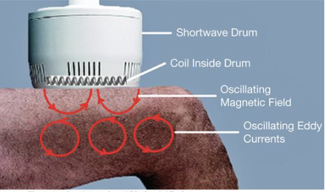 <ul><li><p><span>Creates a stronger magnetic field than an electrical field.</span></p></li><li><p><span> Induction diathermy relies primarily on a magnetic field to produce changes in tissue</span></p></li><li><p><span>Friction between the rotating dipoles results in an increase in kinetic energy, which results in heat (thermal effects)</span></p></li><li><p><span>With inductor electrodes the patient is in a magnetic field and is not part of the circuit</span></p></li></ul><p></p>