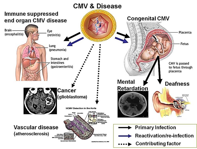 <p>What are comm<strong>on CMV complications</strong> in <strong>AIDS patients?</strong></p>