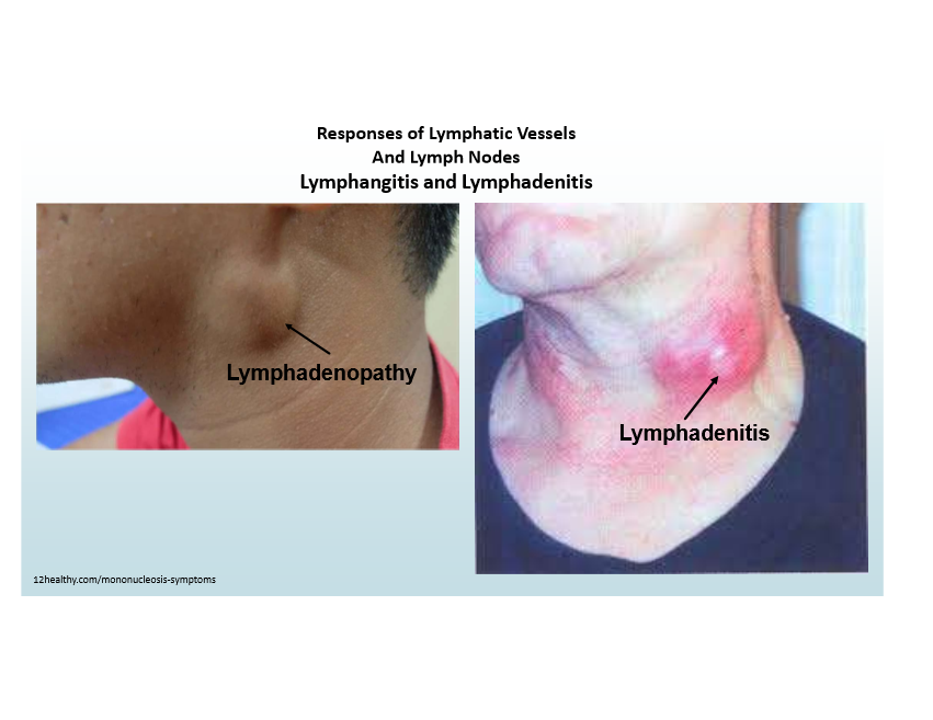 <p>Can become inflamed (lymphangitis), lymph nodes enlarge (lymphadenitis)</p>