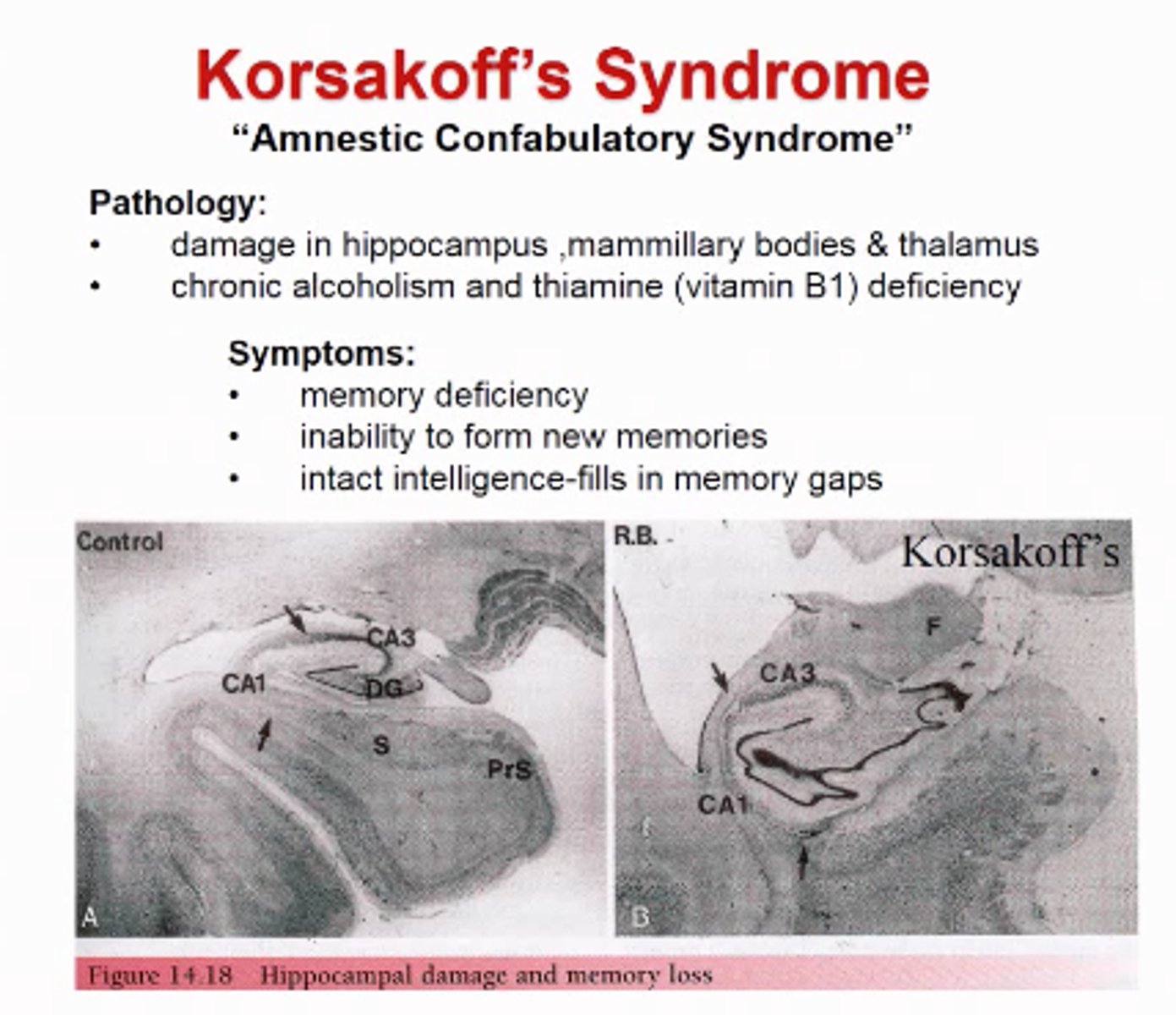 <p>Alzheimers: Unknown cause, problems based more on attention, semantic and abstract thoughts. Progressive and terminal.</p><p>Korsakoff's Syndrome: Caused by lack of B1/thiamine, so lack of glucose metabolism, will have poor balance and abnormal eye movement along with memory/confusion issues. Can be treated and improve.</p>