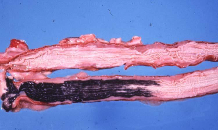 <p>stain of melanosis</p>
