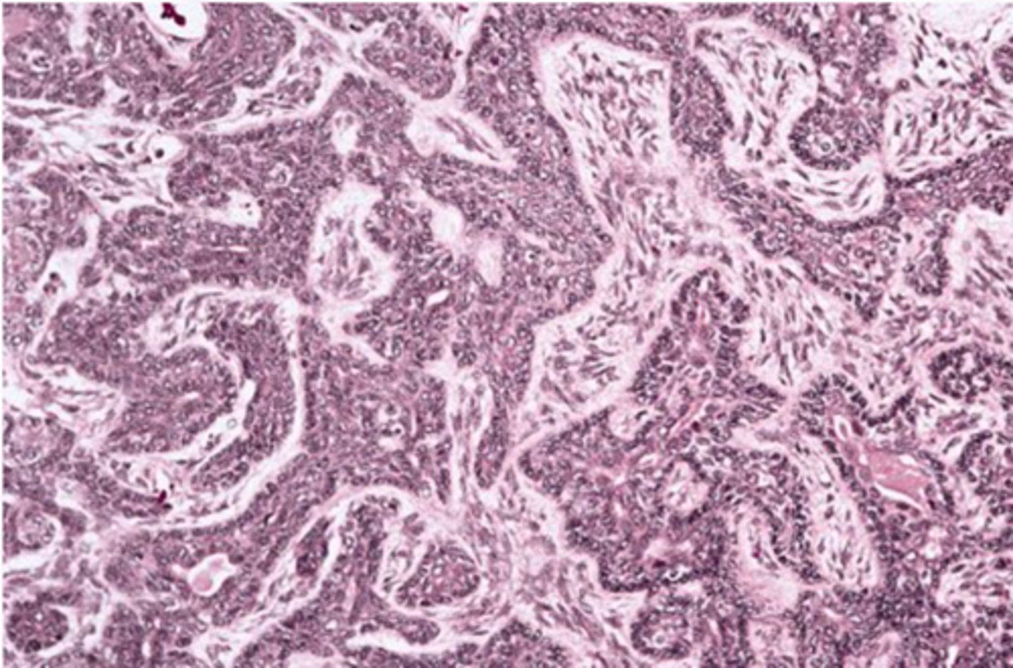 <p>Encapsulated, Islands with</p><p>palisaded cells, Jigsaw pattern, May form ducts</p>
