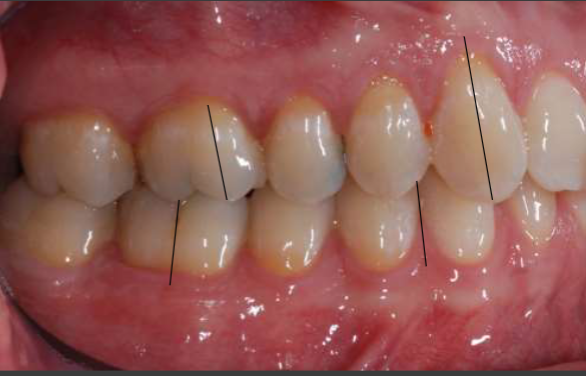 <p>what is the classification of this occlusion </p>