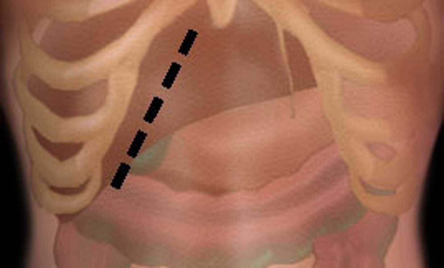 <p>right subcostal incision for open cholecystectomy/RUQ surgery</p>