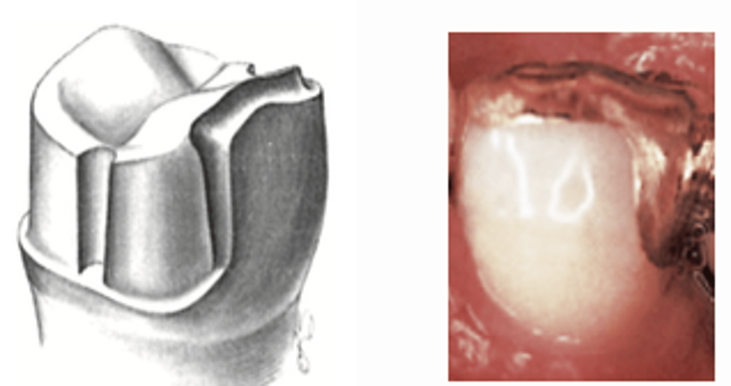 <p>What type of cast partial coverage restoration?</p>