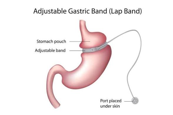 <p>does gastric banding reduce calorie or nutrient absorption?</p>