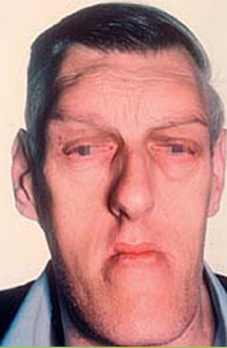 <p>Acromegaly face</p>