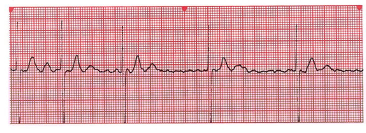 <p>Which Arrythmia is this?</p>