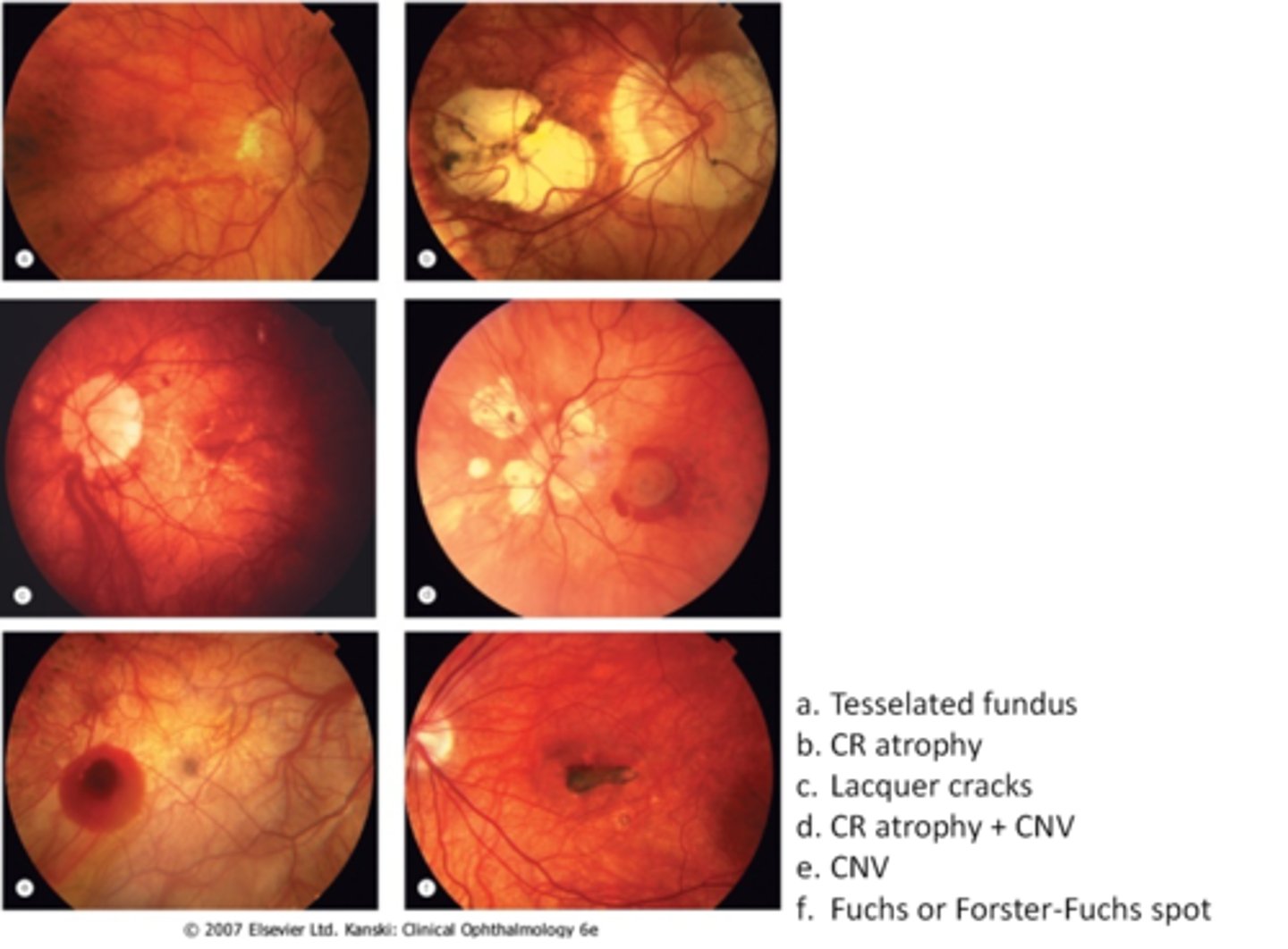 <p>annual exam with DFE</p><p>home Amsler monitoring</p><p>environmental alterations of less near work, wearing protective eyewear</p><p>full correction = avoid under or over minus</p><p>refer to retina if RD, CNV</p>