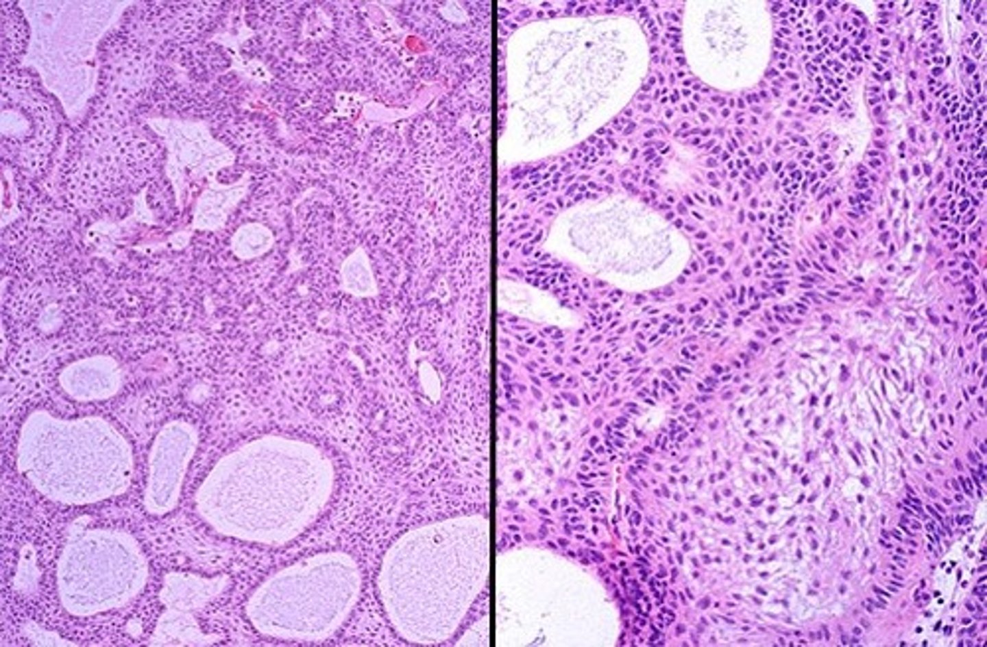 <p>CPH with fibrovasculuar core covered by mature squamous epithelium</p>