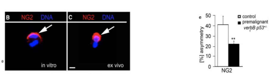 <p>Studies in mouse models have shown that oligodendrocyte progenitor cells (OPC) carrying tumor-initiating</p><p>mutations are a cell of origin of oligodendroglioma, a progressive primary malignancy of the adult central</p><p>nervous system and major glioma class.</p><p>Fig. B&amp;C dividing non-cancer cells labelled for the proteoglycan, NG2. E) Asymmetric divisions in WT and a</p><p>mouse model of glioma were compared. Modified from Sugiarto et al, 2011.</p>