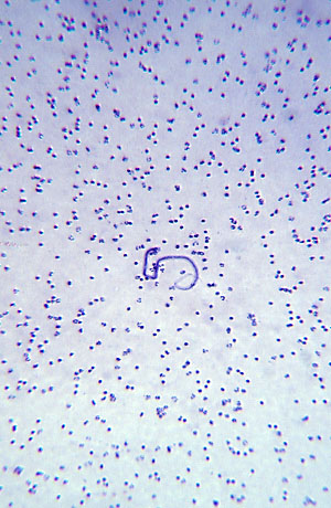 Wuchereria broncrofti microfilariae
