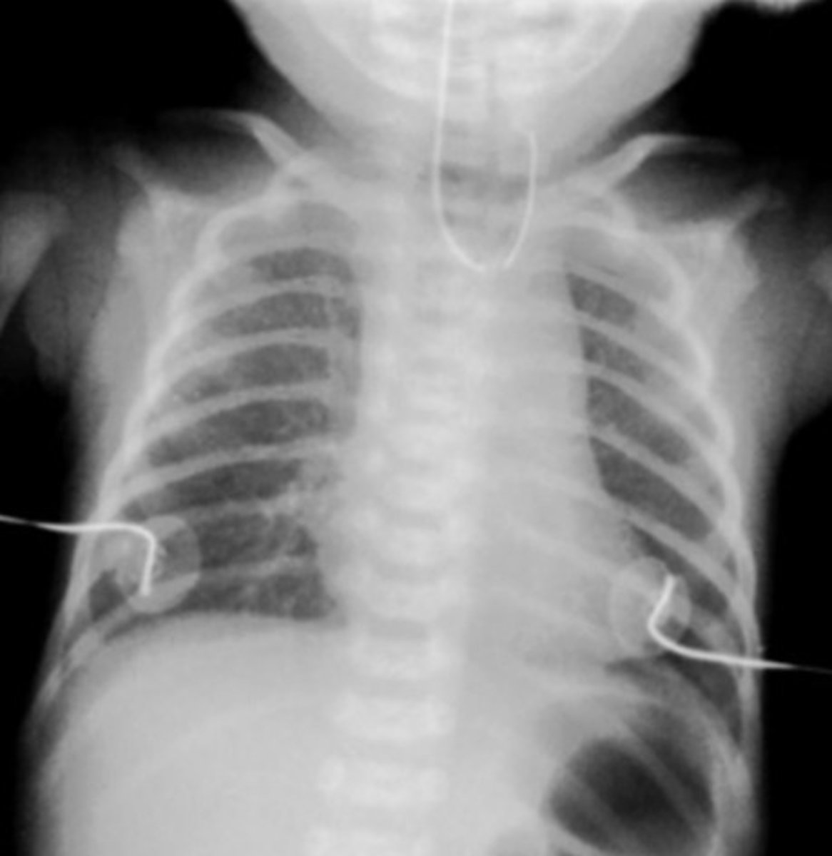 <p>Plain film (CXR) - blind upper pouch appearance as well as a coiled NG tube; echocardiogram (remember condition is part of VACTERL)</p>