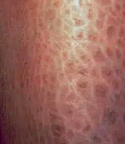 <p>cornification of skin</p><p>plate-like </p><p>associated to inflammatory disease</p>