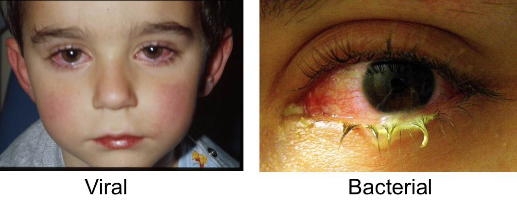 Conjunctivitis (pinkeye): (Bacterial diseases of the eye)