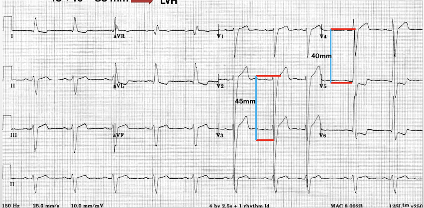 <p>deep S waves in leads V1 &amp; V2, tall R waves in lateral leads, LAD</p><p>-add the deeper S to the taller R; must be + or = to 35 mm</p><p>-if R wave is &gt; 12 mm or if any chest lead is &gt; 45 mm </p>
