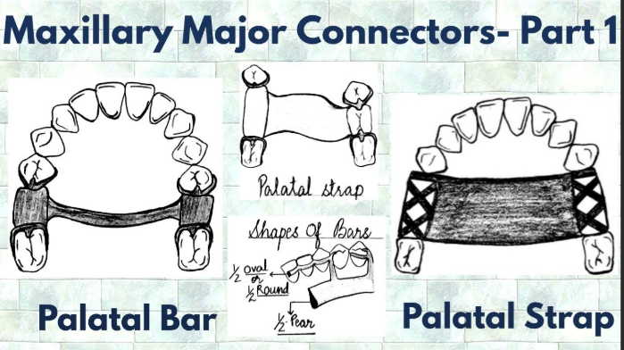 <p>Describe (Mid)palatal strap </p>