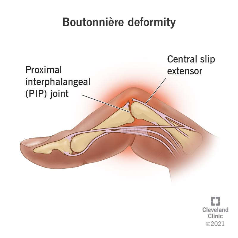 <p>-Extension of MCP and DIP joints and flexion of PIP joint</p><p>-Result of rupture of the central tendinous slip of the extensor hood </p><p>-Most commonly d/t trauma or RA</p>