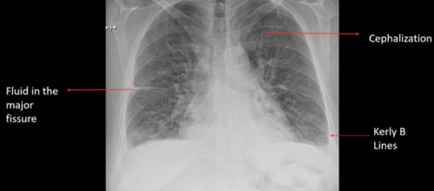 <p>(evaluating AP CXR) fluid in major fissure, cephalization, Kerly B lines</p>