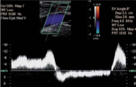 <p>The sonographer is performing a chronic venous insufficiency exam. When the sonographer applies distal compressions, this waveform was seen. </p><ol><li><p>Describe the appearance of this waveform. </p></li><li><p>This waveform can indicate the presence/absence of…</p></li></ol><p></p>