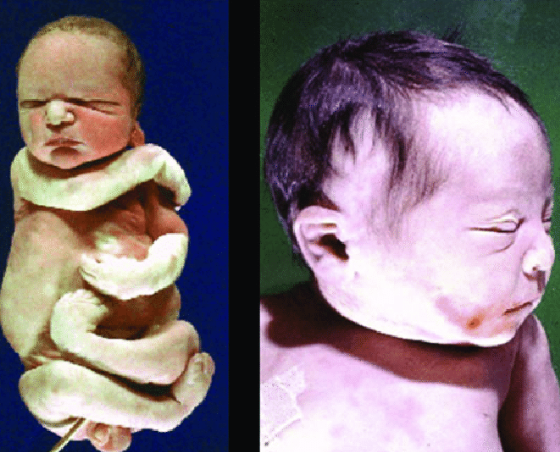 <p>Signs and symptoms of Potter’s disease</p>
