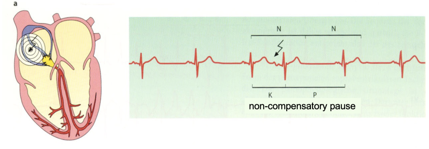 A P wave that is earlier than expected & usually different in shape compared to normal

P wave may also be inverted or hidden within the preceding T wave.

Following the APC, there may be a compensatory pause before the next normal beat.
