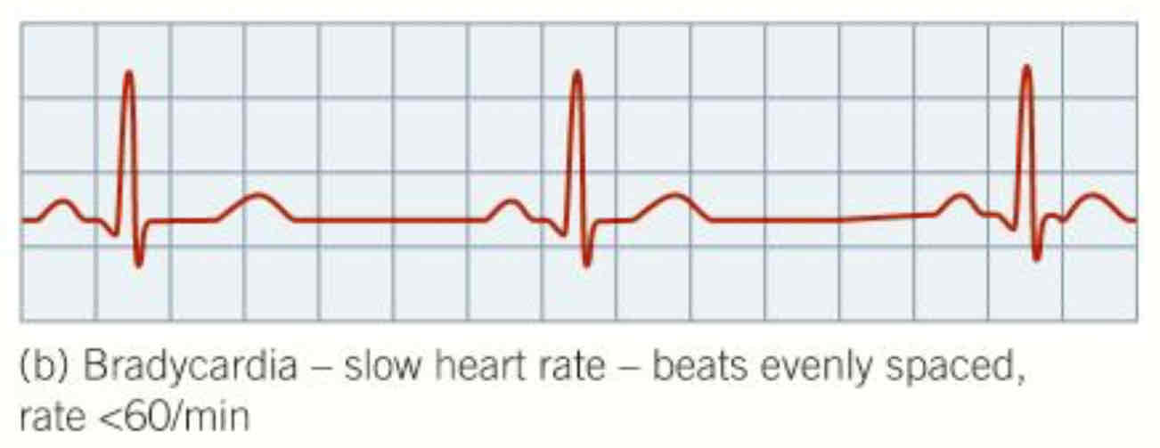 <ul><li><p>heart rate <strong>&lt;60min^-1 </strong></p></li><li><p>normal for fit athletes</p></li><li><p>severs bradycardia can be serious and maybe need artificial pacemaker to keep heart beating steadily  </p></li></ul>