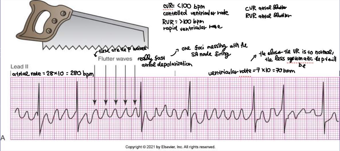 <p><strong>Clinical Manifestations</strong> </p><ul><li><p>Often <strong>asymptomatic</strong> if the ventricular rate is controlled (less than 100 bpm)</p></li><li><p><strong>Symptoms (if rapid ventricular response or decreased cardiac output):</strong></p><ul><li><p>Palpitations / rapid pulse</p></li><li><p>Dizziness or lightheadedness</p></li><li><p>Fatigue or weakness</p></li><li><p>Shortness of breath</p></li><li><p>Chest pain or discomfort</p></li><li><p>Anxiety</p></li></ul></li><li><p><strong>Nursing note:</strong> Look for <strong>irregular ventricular response</strong> and signs of decreased perfusion.</p></li></ul><p> </p><div data-type="horizontalRule"><hr></div><p> <strong>Management / Nursing Actions</strong> </p><ol><li><p><strong>Assess ABCs and vital signs</strong></p></li><li><p><strong>Monitor cardiac rhythm</strong></p></li><li><p><strong>Treat underlying cause</strong> (e.g., hyperthyroidism, heart disease, infection)</p></li><li><p><strong>Medications:</strong></p><ul><li><p><strong>Rate control:</strong> Beta-blockers (e.g., metoprolol), Calcium channel blockers (e.g., diltiazem)</p></li><li><p><strong>Rhythm control / cardioversion:</strong> Amiodarone or synchronized cardioversion if unstable</p></li><li><p><strong>Anticoagulation:</strong> To prevent stroke or a traveling blood clot in general (e.g., warfarin, DOACs)</p></li></ul></li><li><p><strong>Nursing tips:</strong></p><ul><li><p>Observe for <strong>hypotension, syncope, or signs of heart failure (if prolonged due to the weakning of the heart muscle over time due to its excessively fast rate)</strong></p></li><li><p>Educate patient on <strong>medication adherence and stroke prevention</strong></p></li></ul></li></ol><p></p>