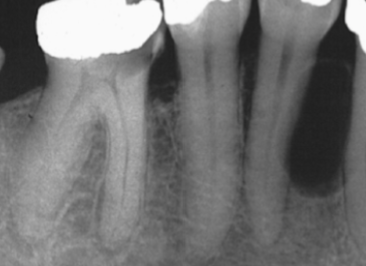 <p><strong>Lateral Periodontal Cyst</strong></p>