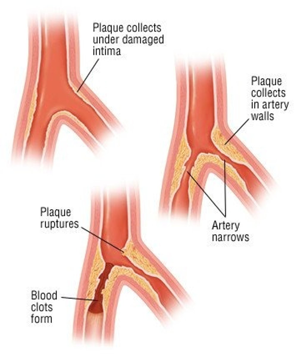 <p>arteriosclerosis may occur throughout the abdominal aorta and at the openings of the celiac trunk and the superior mesenteric and inferior mesenteric arteries</p>